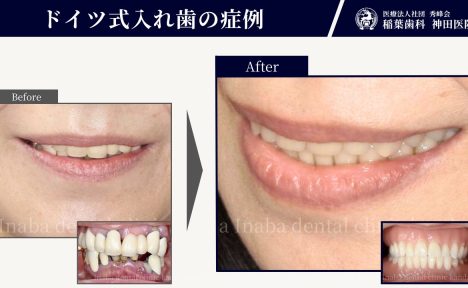 50代女性。留め金でブリッジが揺れ、入れ歯は痛くて噛めない…