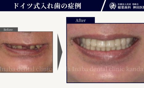 60代男性。歯が揺れて噛めない・見た目も気になる。話す仕事でも安心の入れ歯治療