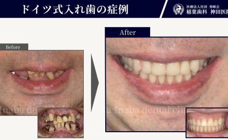 50代男性。インプラントなしで噛めるように。将来的にも不安がない治療をしたい