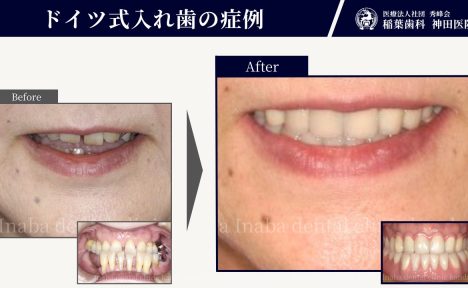 50代女性。入れ歯の痛み、見た目の不満、揺れる歯への不安をドイツ式入れ歯で解消