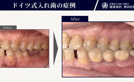 50代男性。インプラントは嫌。でもしっかりと奥歯で噛めるようになりたい…